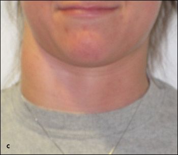 Internal Jugular Phlebectasia | Contemporary Pediatrics