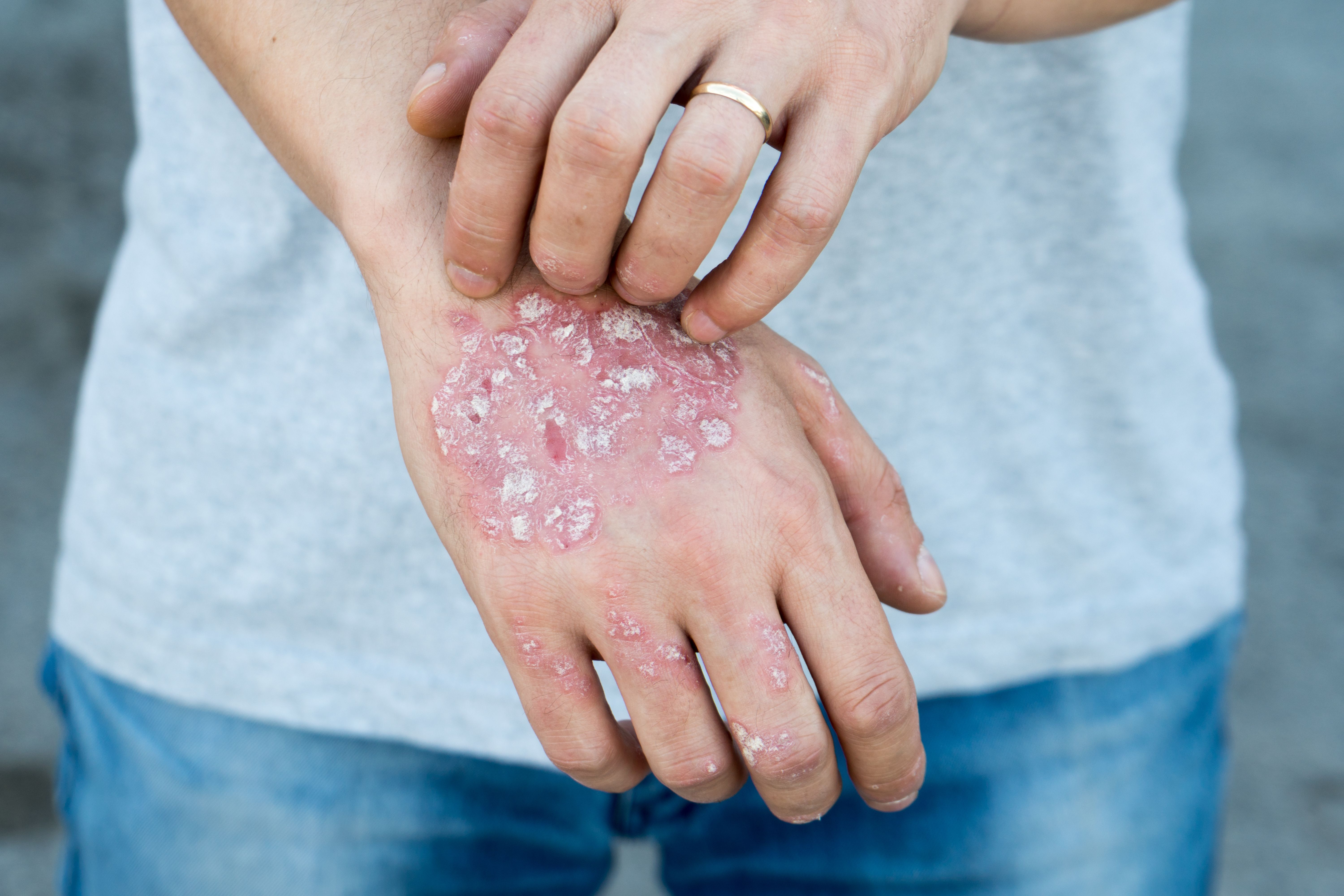 JNJ-2113 for plaque psoriasis demonstrates clear skin in 75% of adolescents | Image Credit: © Ban - © Ban - stock.adobe.com.