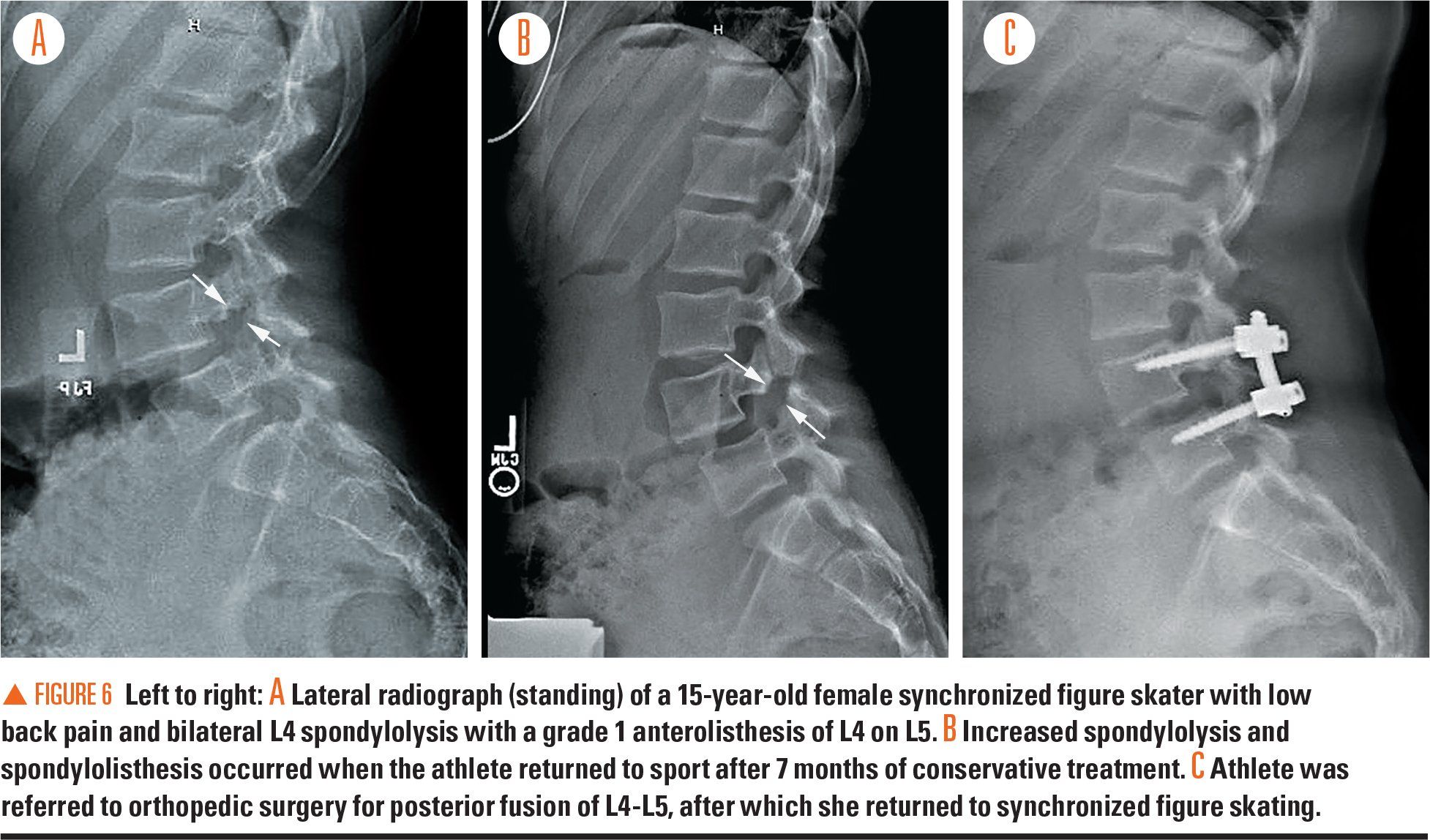 Spondylolysis Underrecognized cause of low back pain