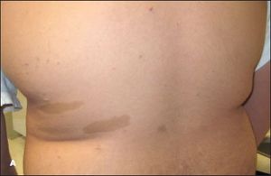 Developmental Delay in a Teen With Neurofibromatosis Type I