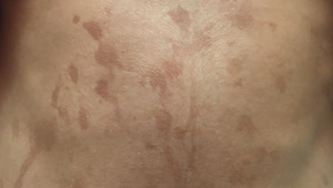 A case of lime disease