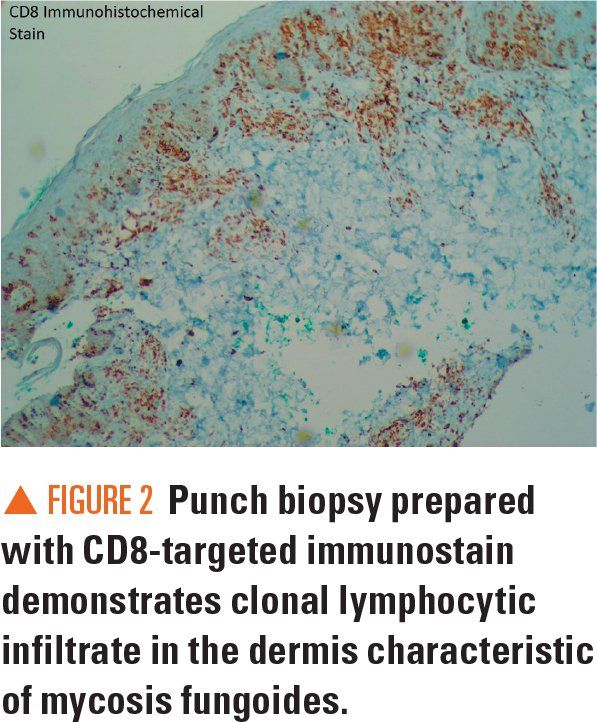 Punch biopsy prepared with CD8-targeted immunostain demonstrates clonal lymphocytic infiltrate in the dermis characteristic of mycosis fungoides.