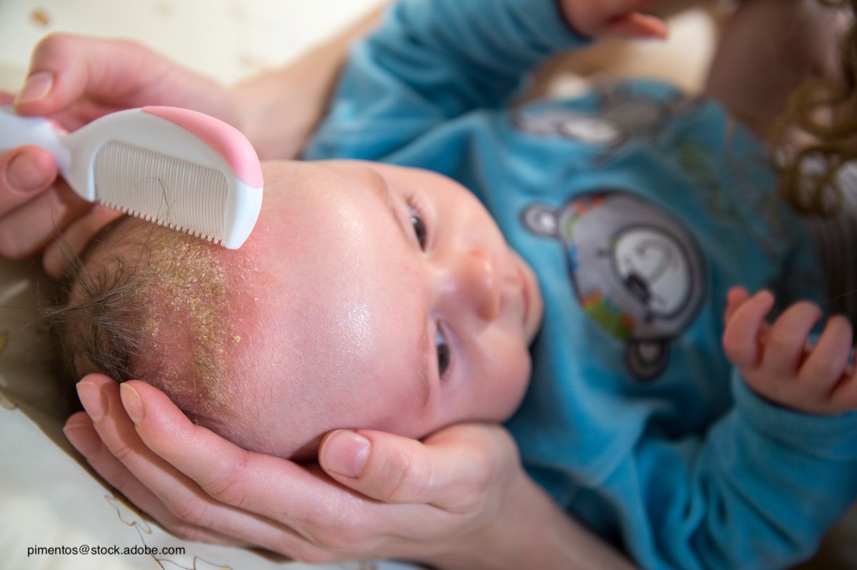 cradle cap on face treatment