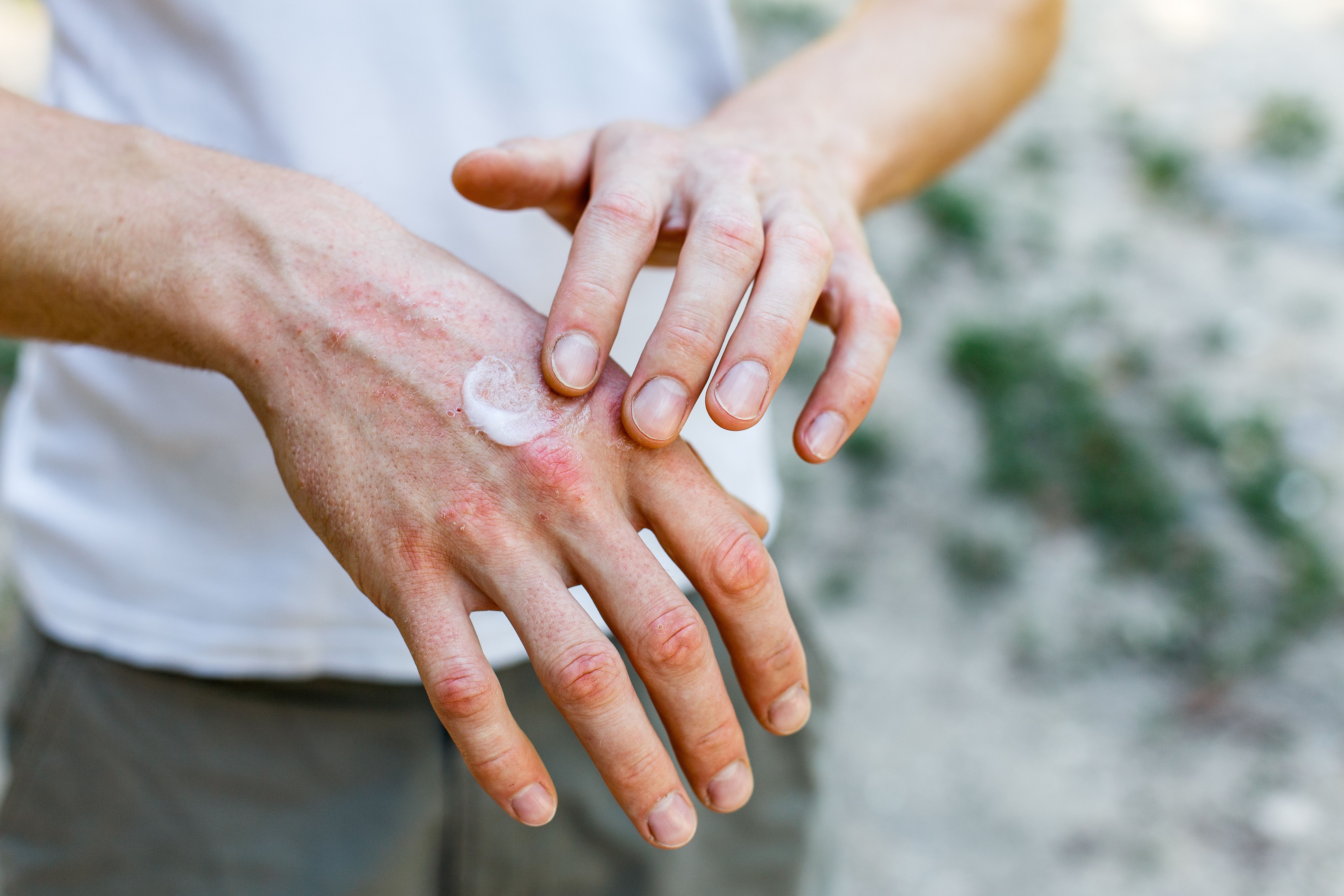 FDA accepts sNDA for delgocitinib in adolescents with chronic hand eczema | Image Credit: © Ольга Тернавская - © Ольга Тернавская - stock.adobe.com.