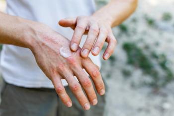 FDA accepts sNDA for delgocitinib in adolescents with chronic hand eczema | Image Credit: © Ольга Тернавская - © Ольга Тернавская - stock.adobe.com.