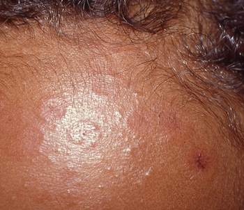 1-month-old boy with annular, red plaques on his scalp and face | Image credit: Author provided