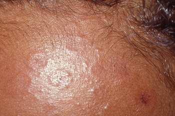 1-month-old boy with annular, red plaques on his scalp and face | Image credit: Author provided