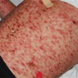 Pityriasis Lichenoides Et Varioliformis Acuta in a 7-Year-Old Boy
