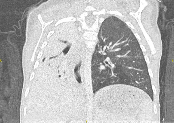 Axial and coronal chest CT views showing mediastinal shift, lung collapse, and bronchiectasis.