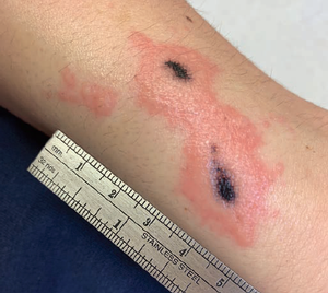 rash on arm