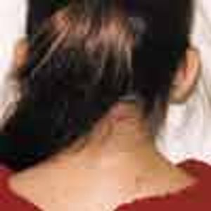 Klippel-Feil Syndrome in a 10-Year-Old Girl