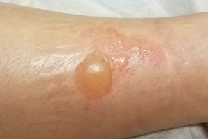 second degree burn on leg