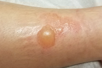 second degree burn on leg