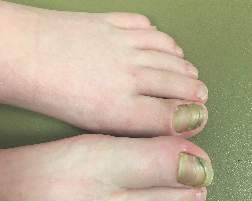 PDF) Congenital Malalignment of the Fourth Toenail with Congenital Curved  Nail of the Contralateral Fourth Toe