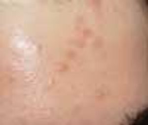 Complications of Chickenpox