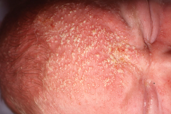 Neonatal pustular facial rash | Image credit: Author provided