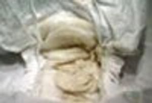 A 1-Month Old Girl With Acholic Stools