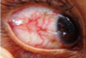 Ataxia-Telangiectasia