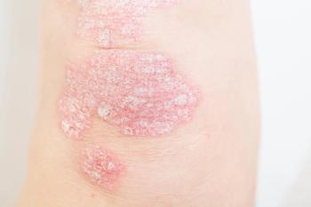 EADV: Icotrokinra maintains long-term efficacy, safety for plaque psoriasis | Image Credit: © SNAB - © SNAB - stock.adobe.com.