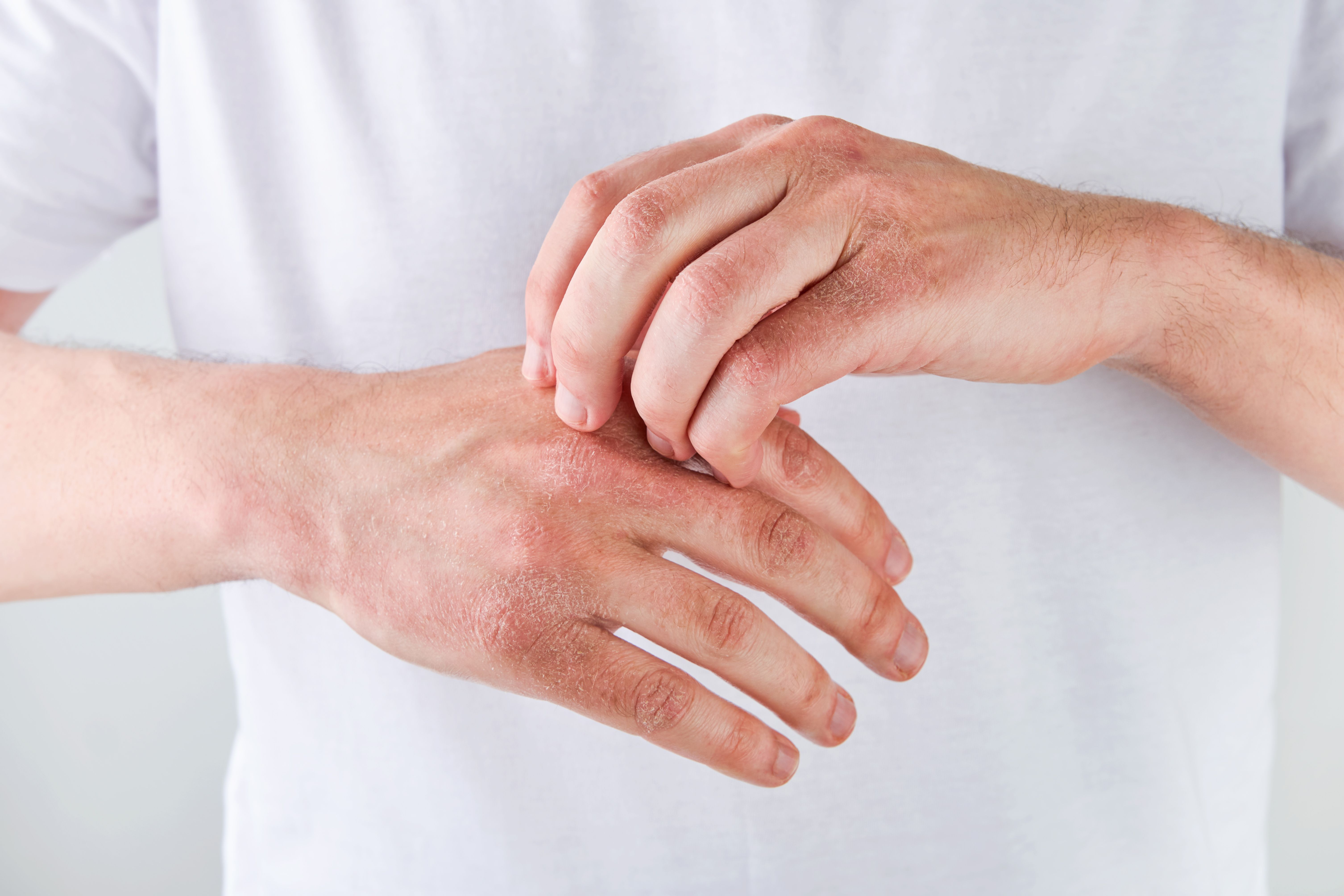Phase 3: delgocitinib improves chronic hand eczema in adolescents | Image Credit: © kasia2003 - © kasia2003 - stock.adobe.com.