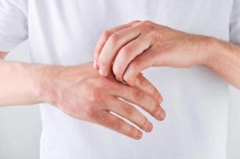Phase 3: delgocitinib improves chronic hand eczema in adolescents | Image Credit: © kasia2003 - © kasia2003 - stock.adobe.com.