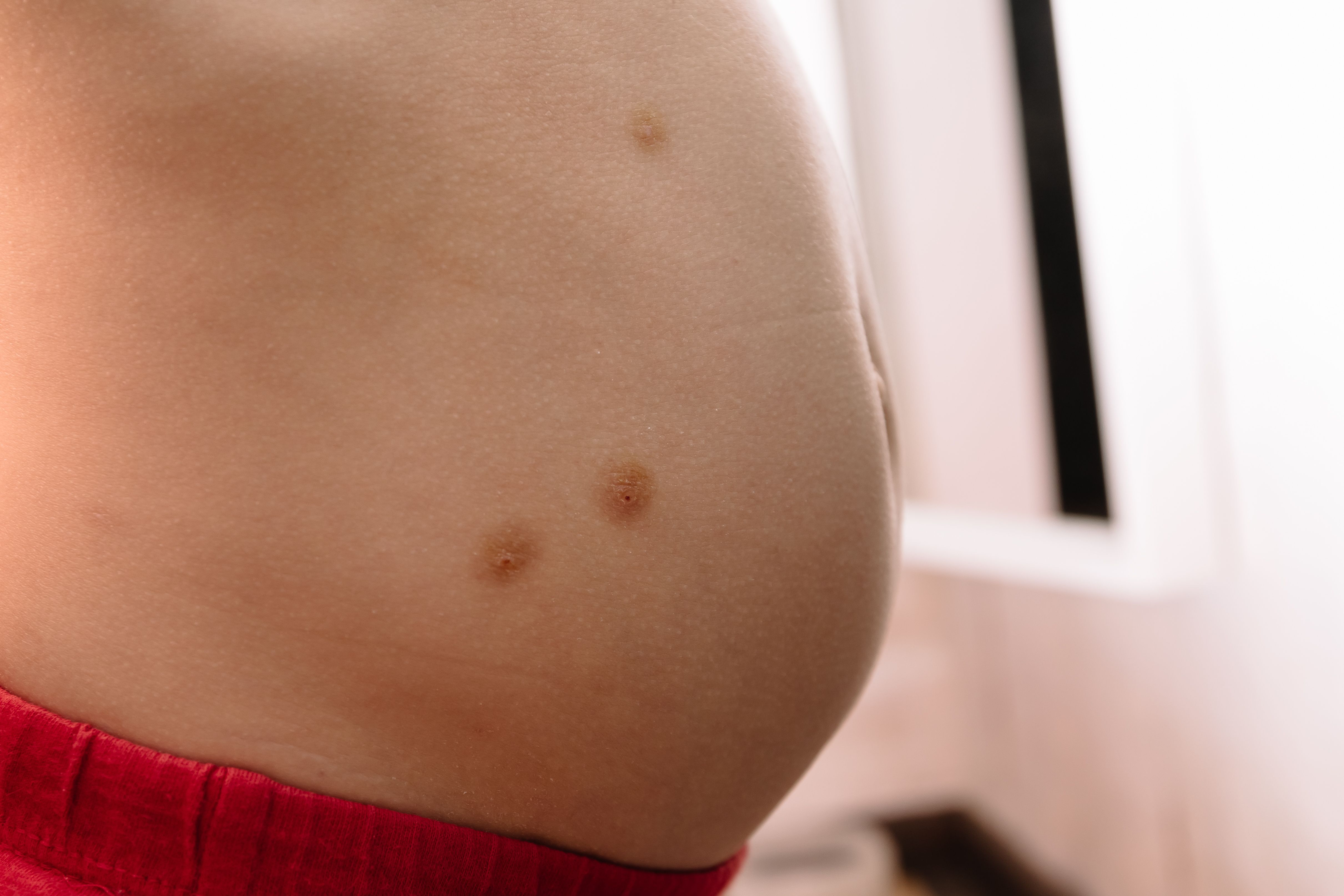 molluscum contagiosum