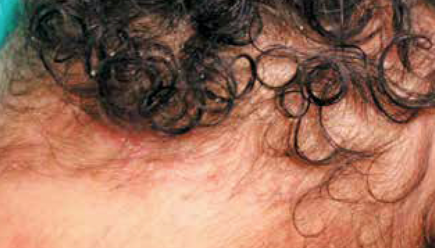 Diffuse rash spreads from infant’s scalp to extremities | Contemporary ...