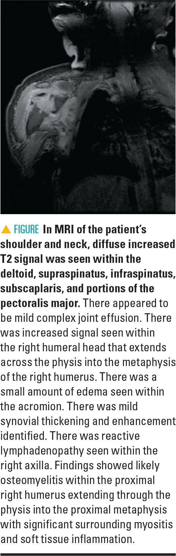 MRI of patient's shoulder and neck