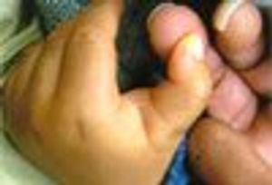 What Is This Thumb Anomaly?