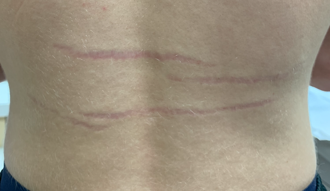 Bruiselike marks on a healthy teenage male’s back