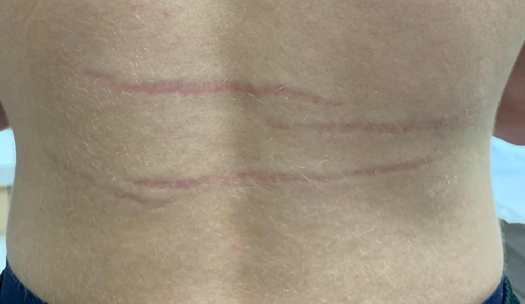 Bruise-like marks on a healthy teenage male's back