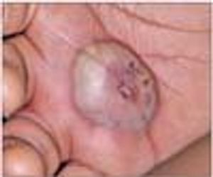 MRSA Abscess Attributed to Spider Bite