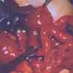 WHAT'S YOUR DIAGNOSIS? CLOACAL EXSTROPHY