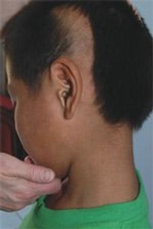 Trichotillomania