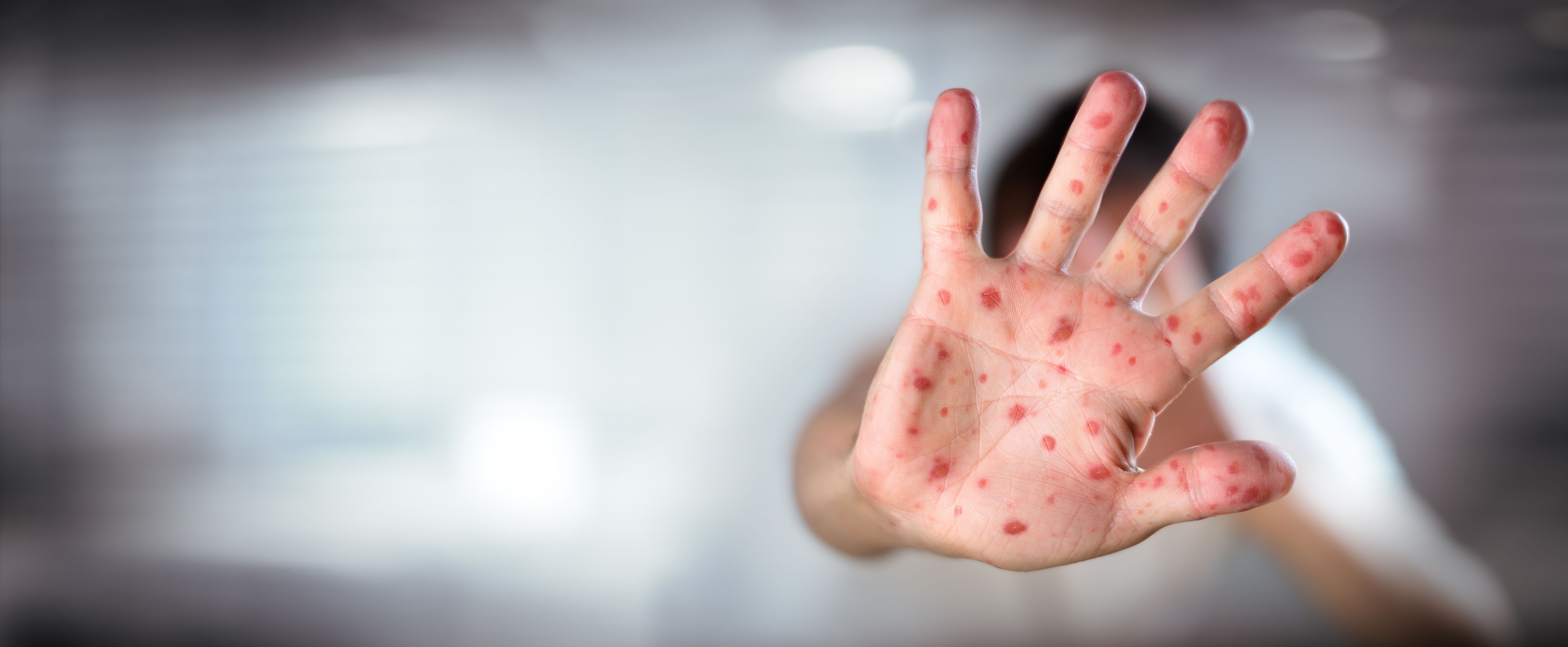 US measles cases reach new record high since eradication declaration in 2000 | Image Credit: © Romolo Tavani - © Romolo Tavani  - stock.adobe.com.