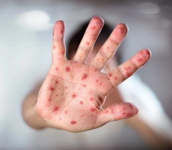 US measles cases reach new record high since eradication declaration in 2000 | Image Credit: © Romolo Tavani - © Romolo Tavani  - stock.adobe.com.
