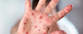 US measles cases reach new record high since eradication declaration in 2000 | Image Credit: © Romolo Tavani - © Romolo Tavani  - stock.adobe.com.