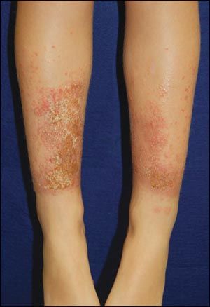 Can Shin Guards Cause a Rash: Surprising Skin Irritation Facts