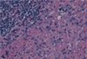 A Young Girl With Unexplained Cervical Lymphadenopathy: Infection? Lymphoma--or Something Else?