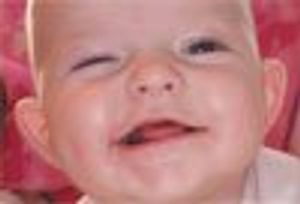 5-Month-Old Girl With Left Facial Droop of Sudden Onset