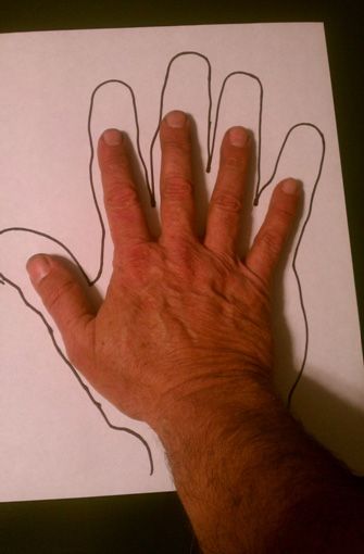 Child Abuse - or Mimic? Suspicious Bruises: An Old Story with a