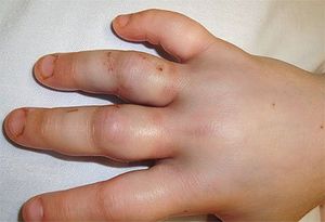 Snakebite Envenomation