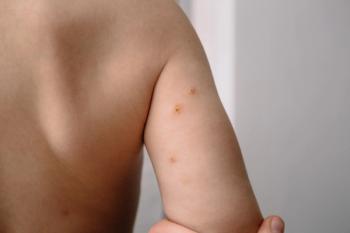 Berdazimer gel improves clearance rates in phase 3 molluscum contagiosum trial | Image Credit: © molluscum contagiosum - stock.adobe.com.