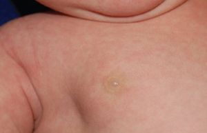 Galactorrhea of the Newborn (Witch’s Milk)