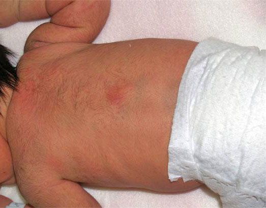 Subcutaneous Fat Necrosis Subcutaneous Fat Necrosis