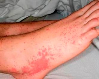 Henoch Schonlein Purpura In A 14 Year Old Boy Henoch Schonlein Purpura In A 14 Year Old Boy
