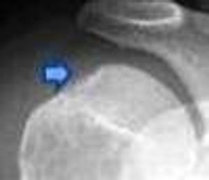 An Extremely Specific Sign of an Anterior Shoulder Dislocation