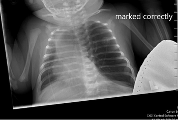 Full case: 18-day-old female with reported apnea, cyanosis, and decreased feeding | Image credit: Author provided