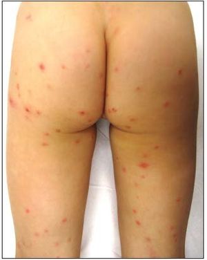 Hot Tub Folliculitis in a 5-Year-Old Girl