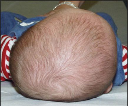 Bald going weird head shaped Baby's head